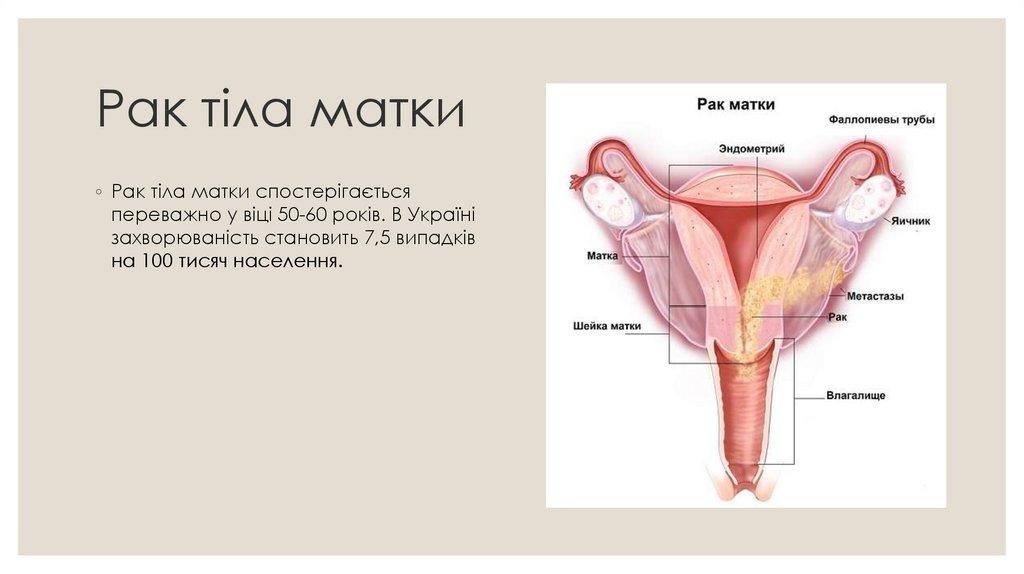Рак тіла матки